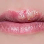 Effective Remedies for Cold Sores: Heal and Prevent Outbreaks
