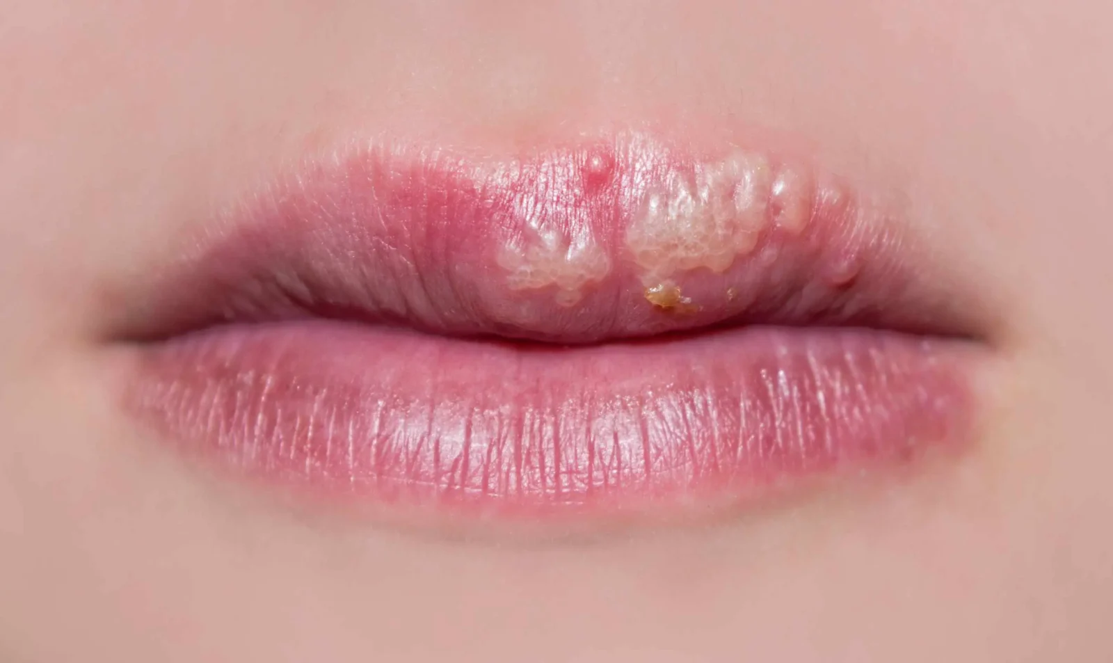 Effective Remedies for Cold Sores: Heal and Prevent Outbreaks