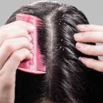 Effective Home Remedies for Dandruff: Get Rid of Flakes