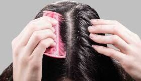 Effective Home Remedies for Dandruff: Get Rid of Flakes