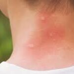 Top 3 Best Remedies for Bug Bites: Soothe Itching and Swelling