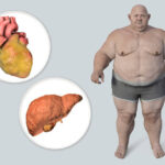 Reversing Fatty Liver Disease with Diet: 3 Essential Foods for Liver Health in 2024