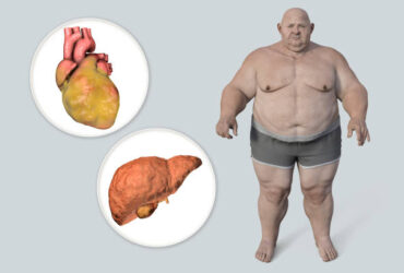 Reversing Fatty Liver Disease with Diet: 3 Essential Foods for Liver Health in 2024